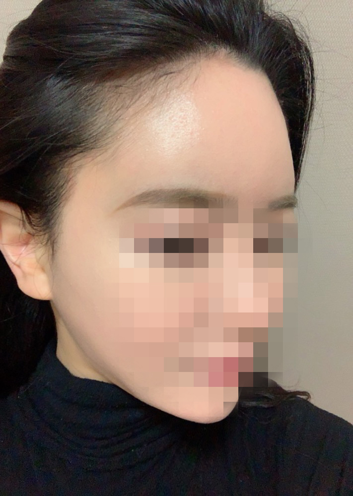 03.이윤주 수술3달.jpg