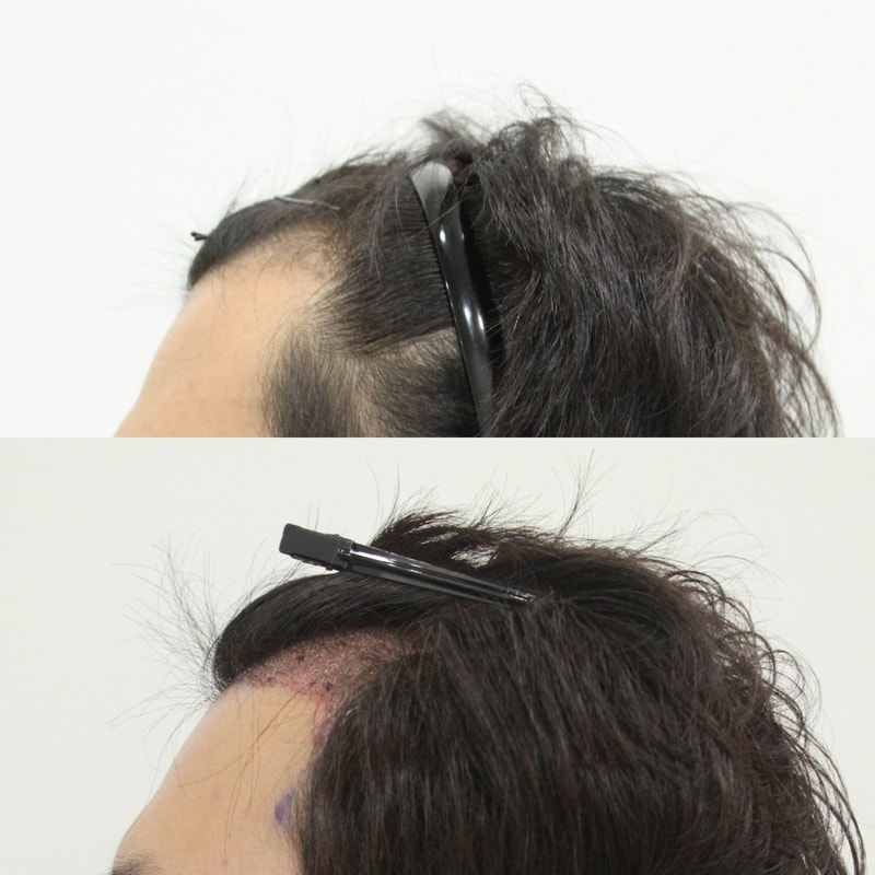 모발이식 1.jpg