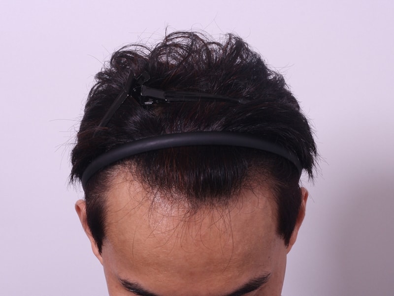 수술전.jpg