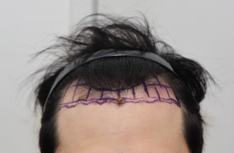 New Hairline Correction 1700 Hair Orthodontic 7 Days Review