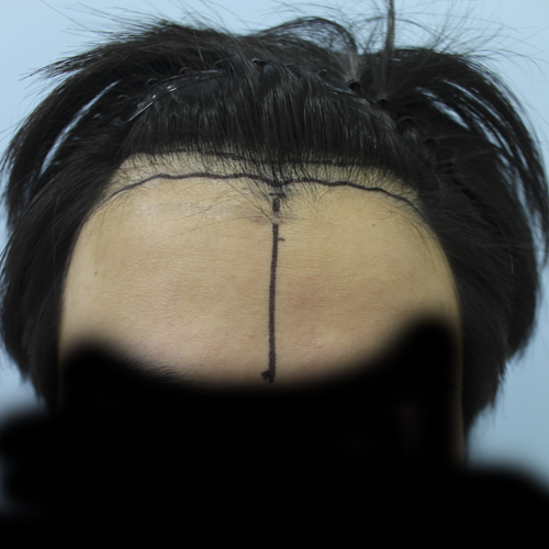 헤어라인 한나이브에서 이식을 했습니다