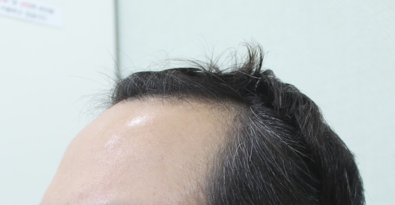 김 오영_20171006_모발_124384.png