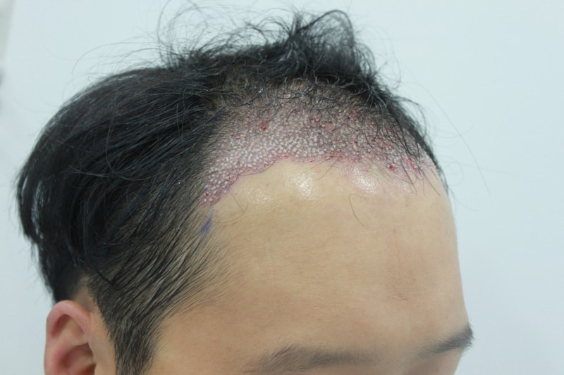 수술후...JPG