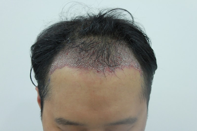 수술후.JPG