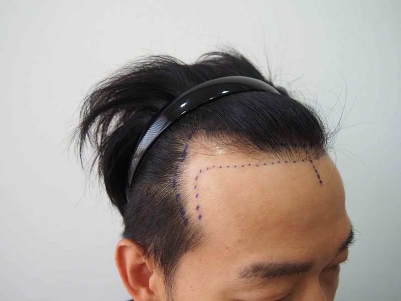 크기변환_수술전1.JPG