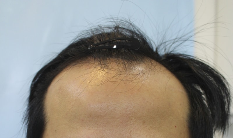 이식전  (2).png