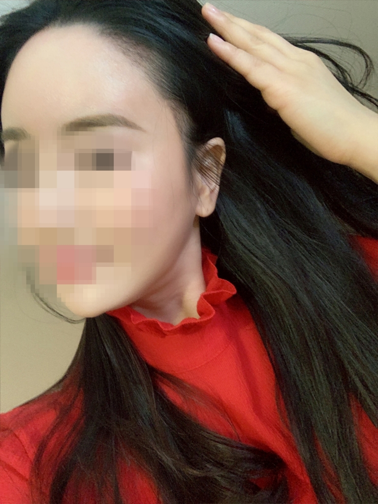 수술한달02.jpg