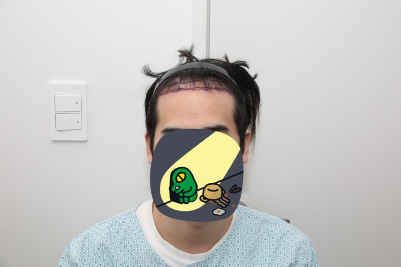 뉴헤어 서울점 비절개 모발이식 2000모낭 6개월 후기