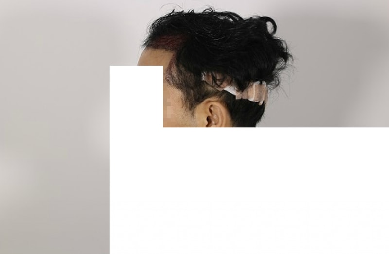 남 모발이식직후1.png