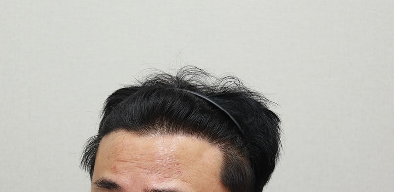 6. 1년 1개월 경과.JPG