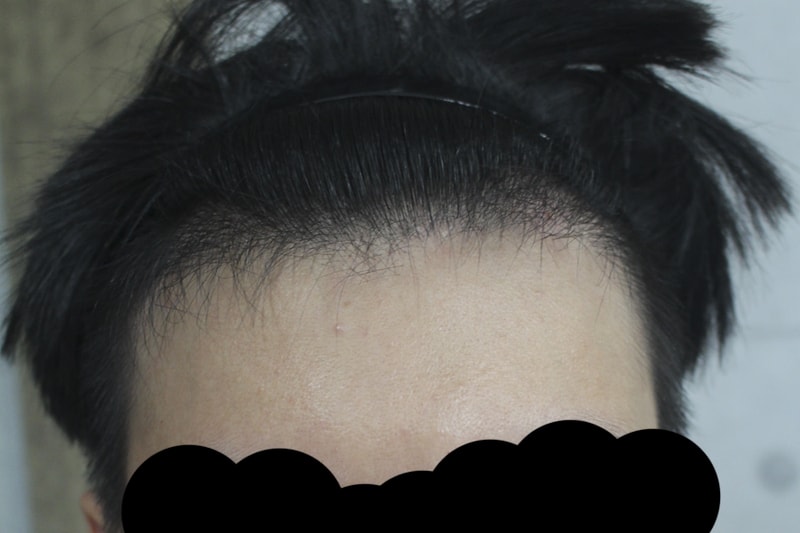 2600모 이식하고 5개월 되어서 사진 올려봐요