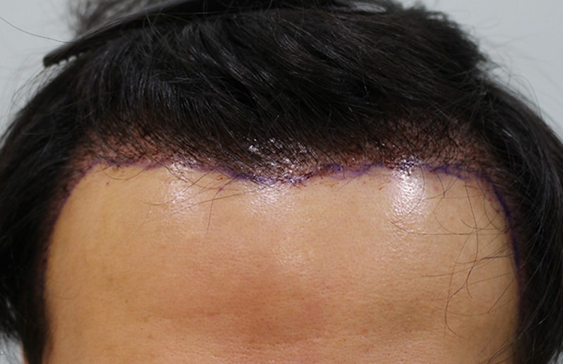 수술다음날 (2).JPG