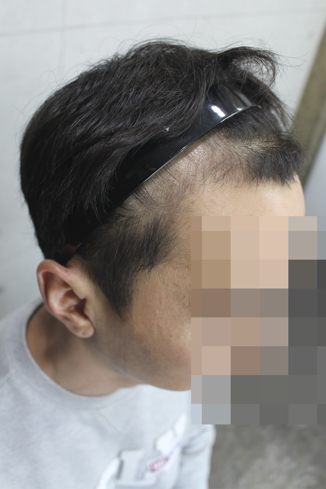 M자 이식하고 3개월이 지나가는 중입니다