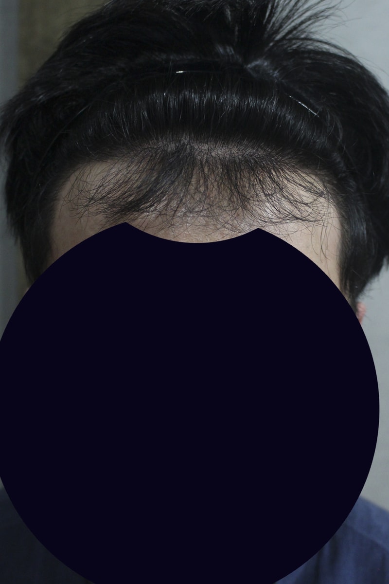 2300모 이식한지 10개월 되었습니다