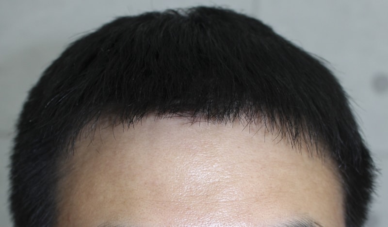 술후8달 경과 (8).png