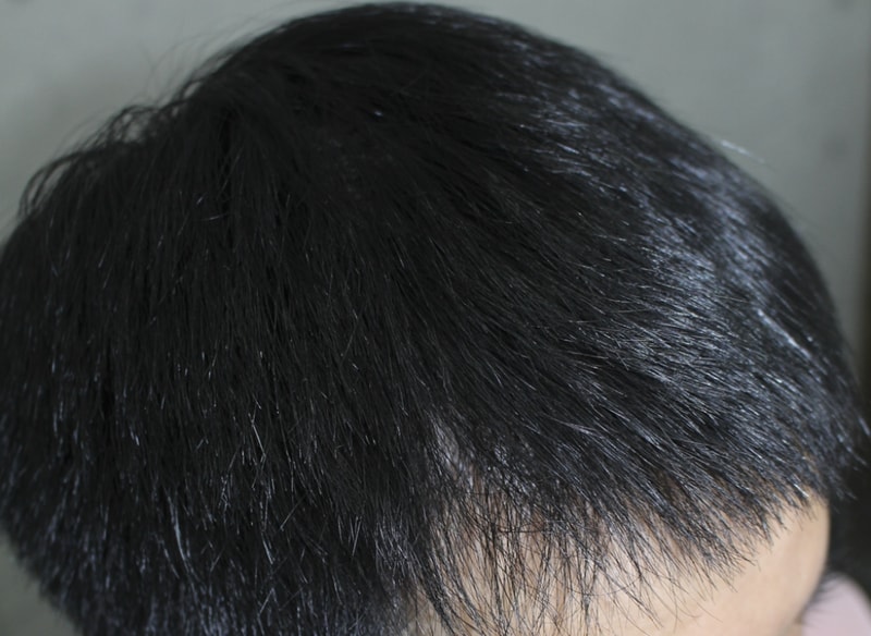 술후8달 경과 (1).png