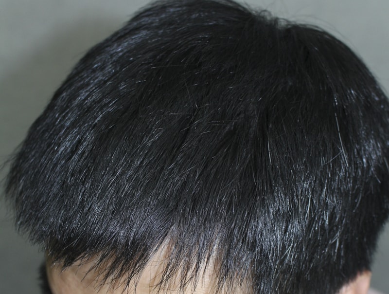 술후8달 경과 (3).png