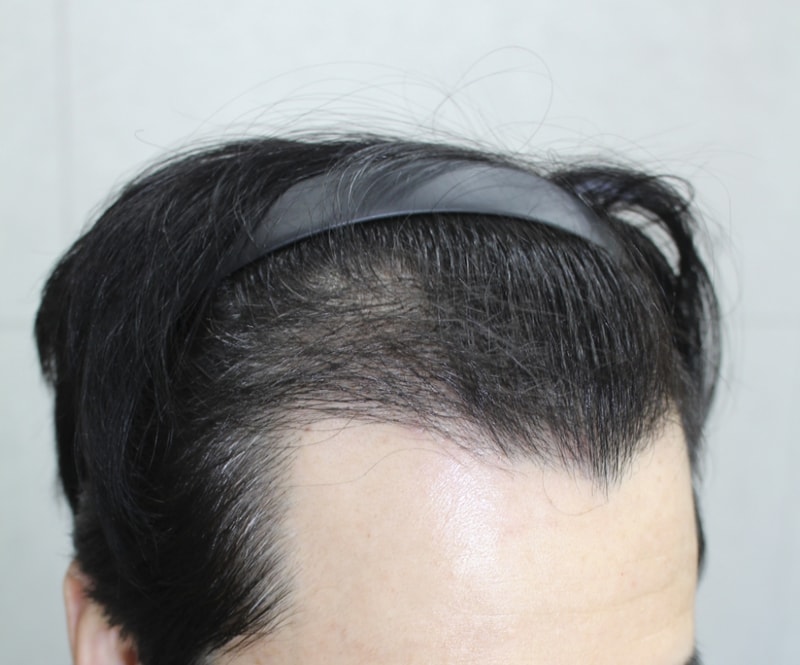 수술후5달경과 (3).png