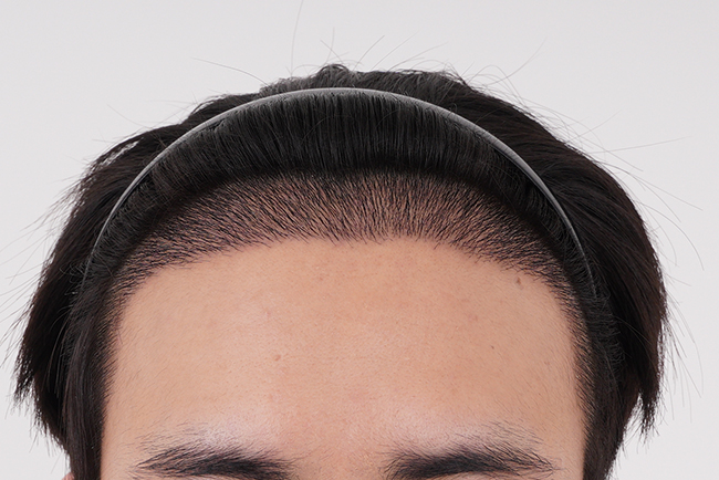 Momo's Daegu branch incision 4,500 hair transplant is 2 weeks late