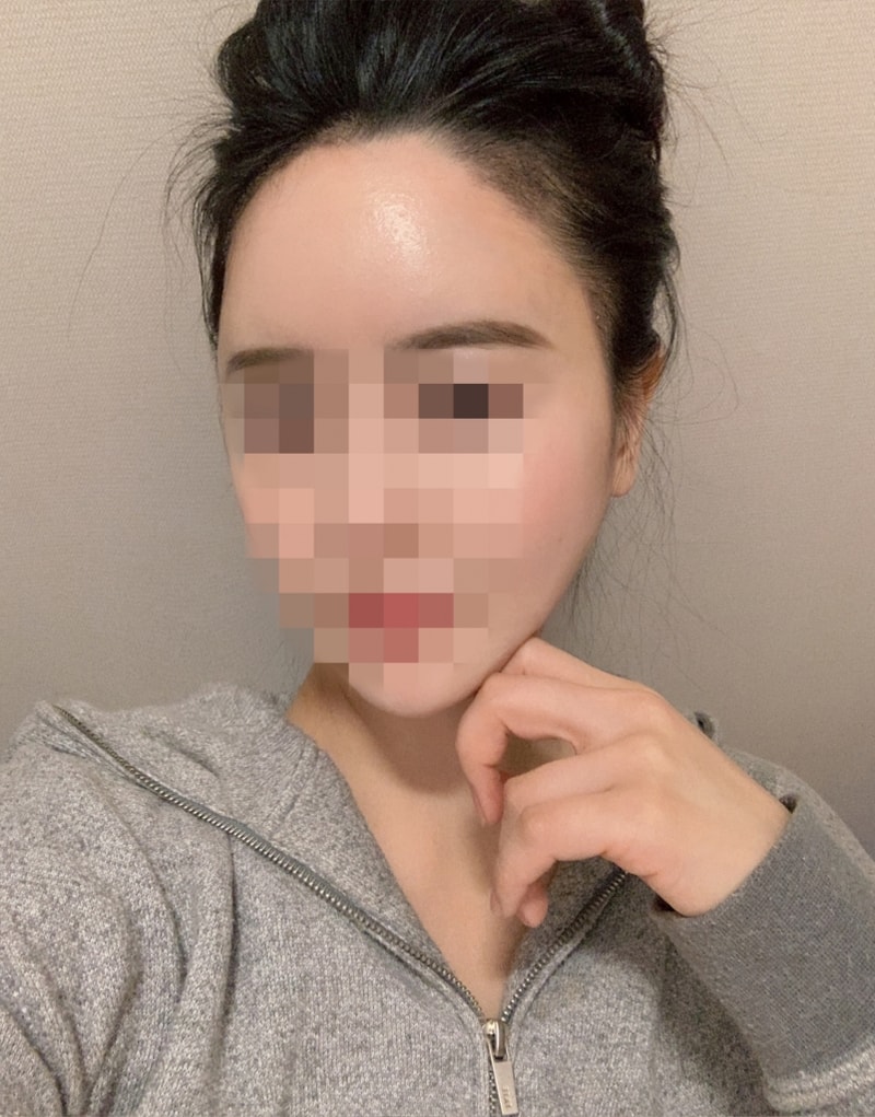 수술일주일03.jpg