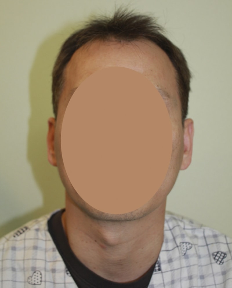 모발이식전_01.jpg