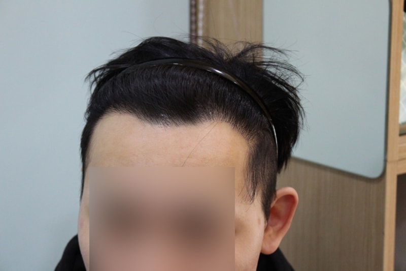 수술후 8개월 (1)_1.jpg