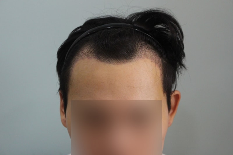 수술후 10일 (6)_1.jpg
