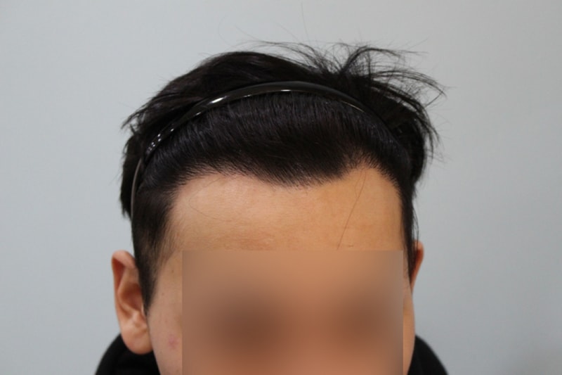 수술후 8개월 (3)_1.jpg