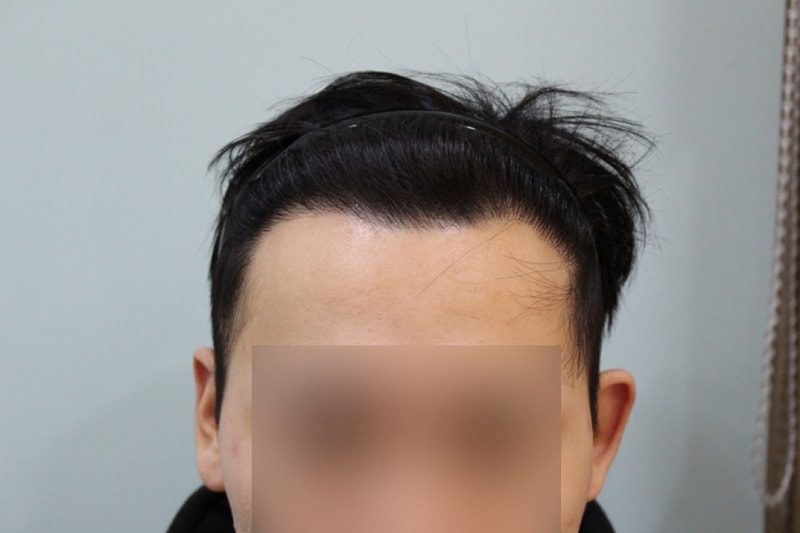 수술후 8개월 (5)_1.jpg
