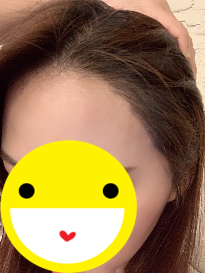 다나성형외과, 8개월 후기