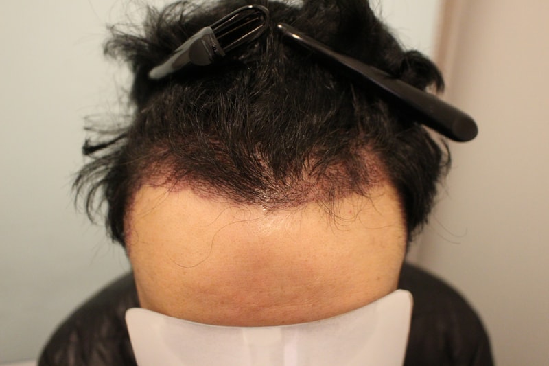 수술후 1일 2.JPG