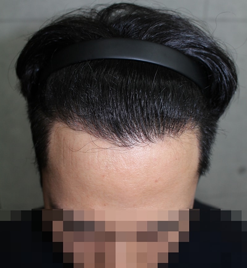 수술후.png
