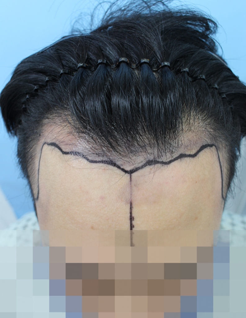 절개 3천모 후기 저도 한번 남겨봅니다