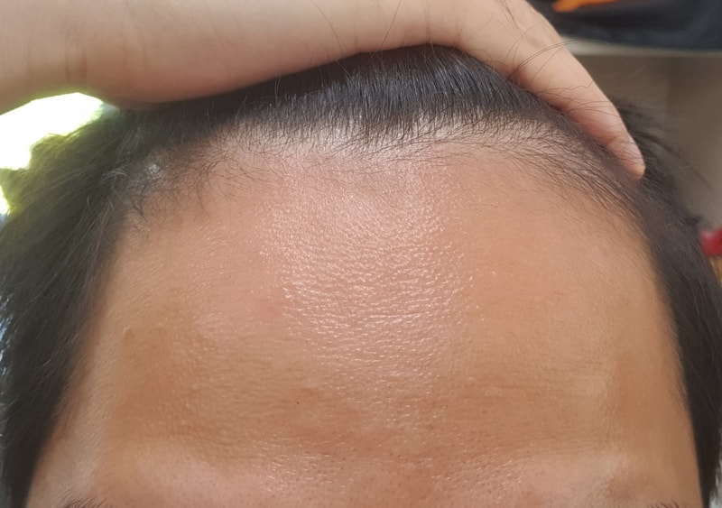 뉴헤어 강남점 모발이식 후 4일째 후기
