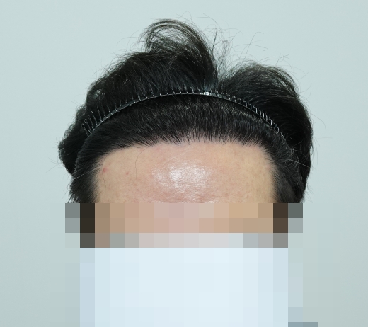 12개월차 이마라인 정면.jpg