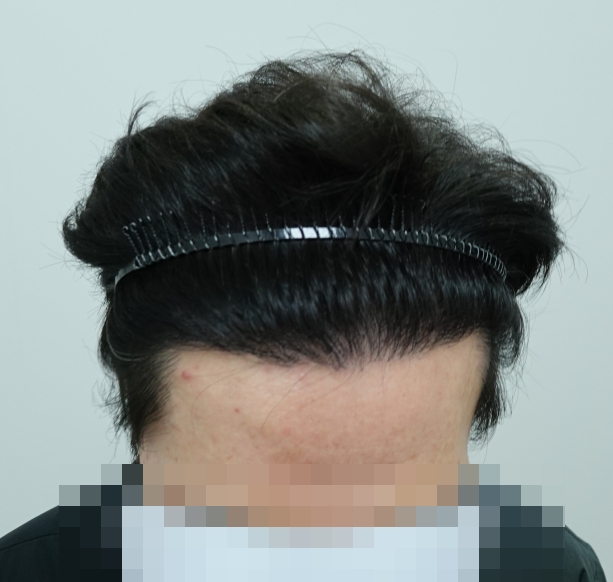 12개월차 이마라인 위.jpg