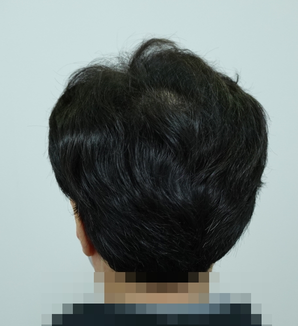 12개월차 정수리.jpg