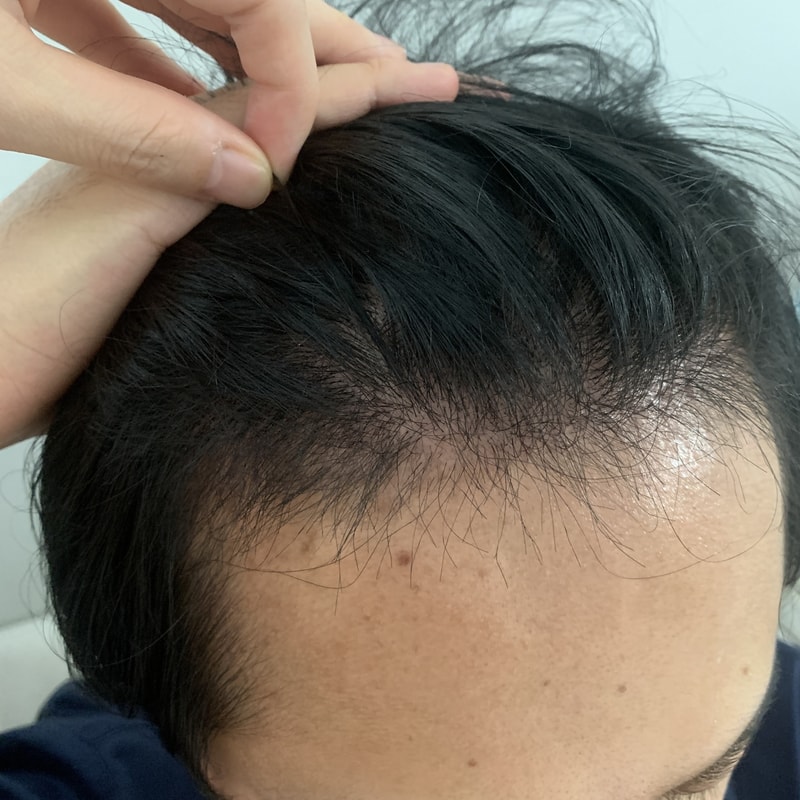다나성형외과 비절개무삭발 수술 46일차입니다.
