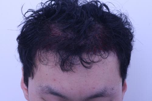 수술직후.JPG