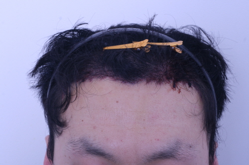수술후1일.JPG