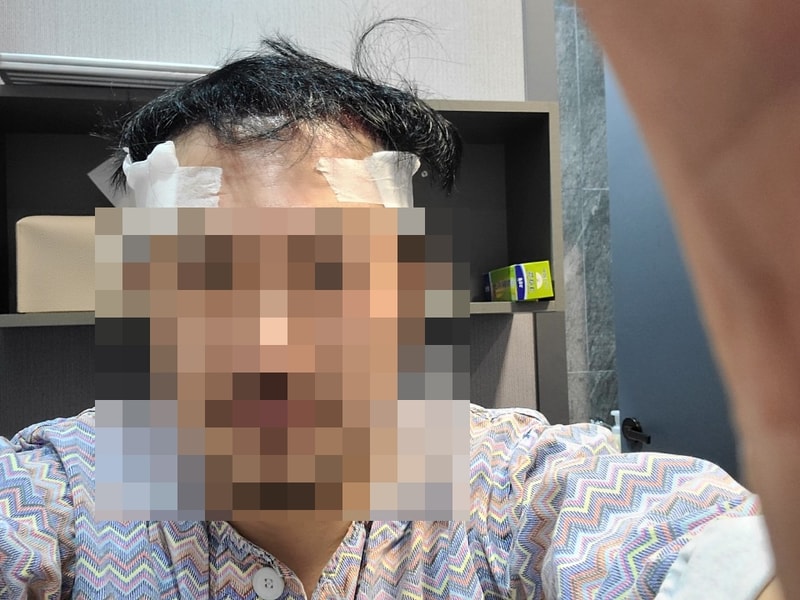 광주 압구정모비앙의원(최현용 원장) 3800모 모발이식 14일차 후기