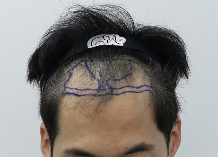 압구정 맘모스헤어라인 모발이식 1일차후기