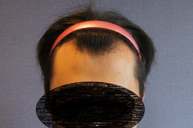 모션 1400모낭 비절개 무삭발 이식 8개월 경과 사진