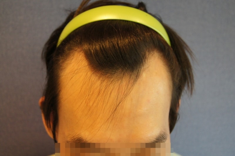 모션 비절개 엠자+헤어라인 1600모낭 이식 후기에요