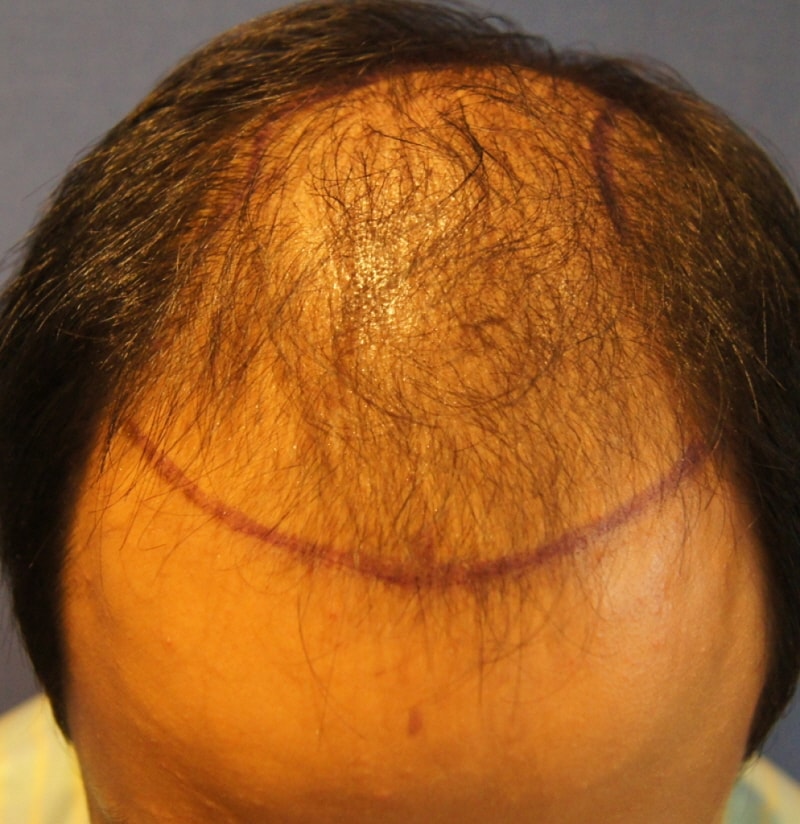 Motion of a young middle school student: 3000 hair follicles 4 months and 15 days have passed
