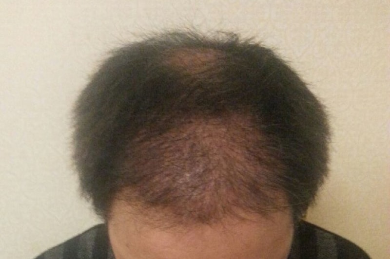모션 앞머리와 정수리 4000모 14개월 입니다