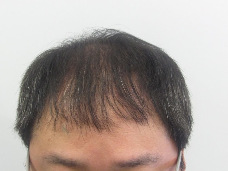 1차10mo, 2차수술전.JPG