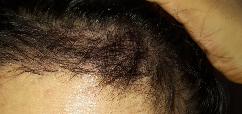 뉴헤어 절개 1600모낭 100일쪼금 안됐습니다.