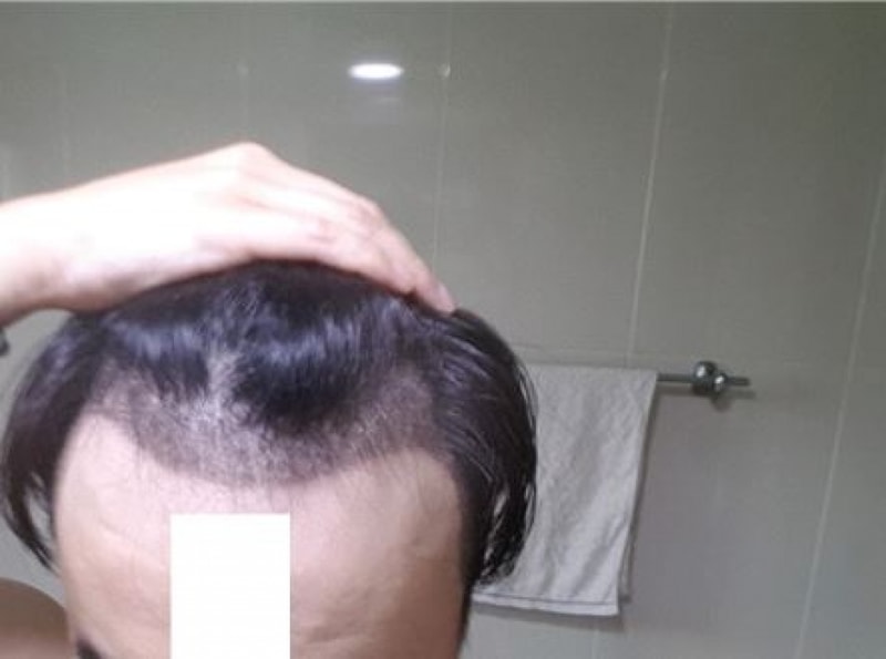 딱지제거후1.JPG
