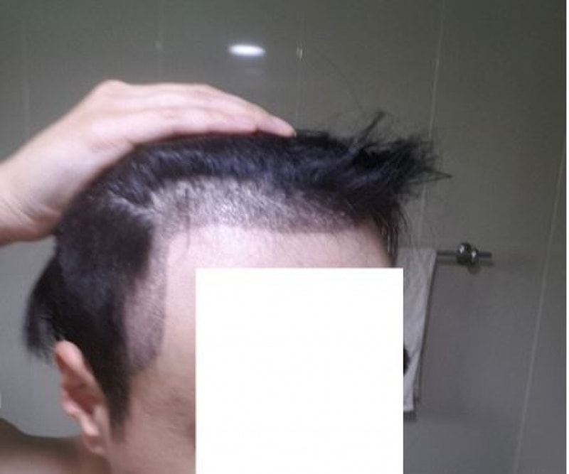 딱지제거후우.JPG